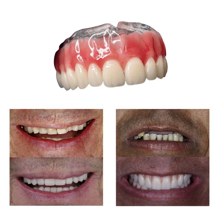 LEVE 2 PAGUE 1 - Dentadura de Silicone FIX | Ajustavel e Adaptativa