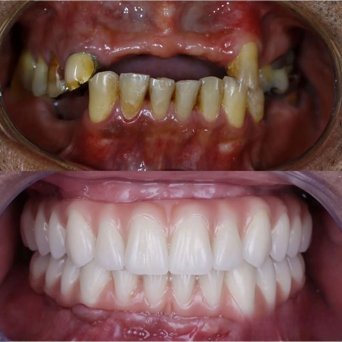 LEVE 2 PAGUE 1 - Dentadura de Silicone FIX | Ajustavel e Adaptativa